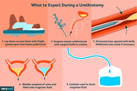 1 Management of ureteric strictures is a significant challenge for. . Urethral dilation side effects